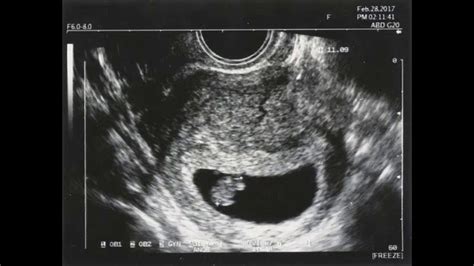 gravidez 7 semanas fotos